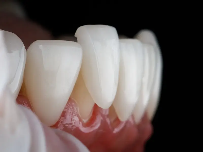 Missori - Faccette dentali Missori - Faccette dentali